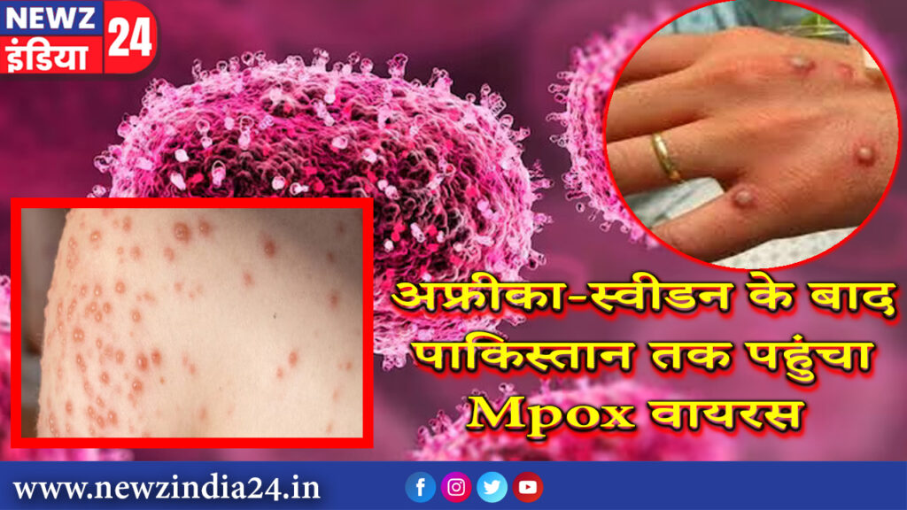 अफ्रीका-स्वीडन के बाद पाकिस्तान तक पहुंचा Mpox वायरस